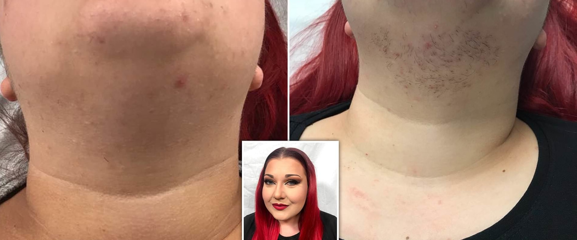 Laser Hair Removal for PCOS: Is it Effective?