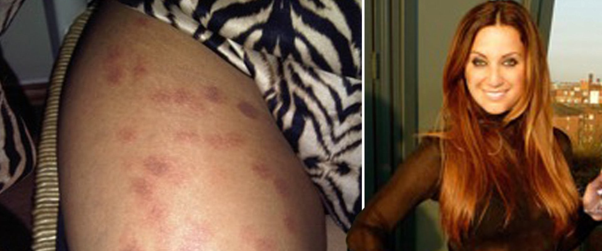 What Happens if You Stop Laser Hair Removal Early?