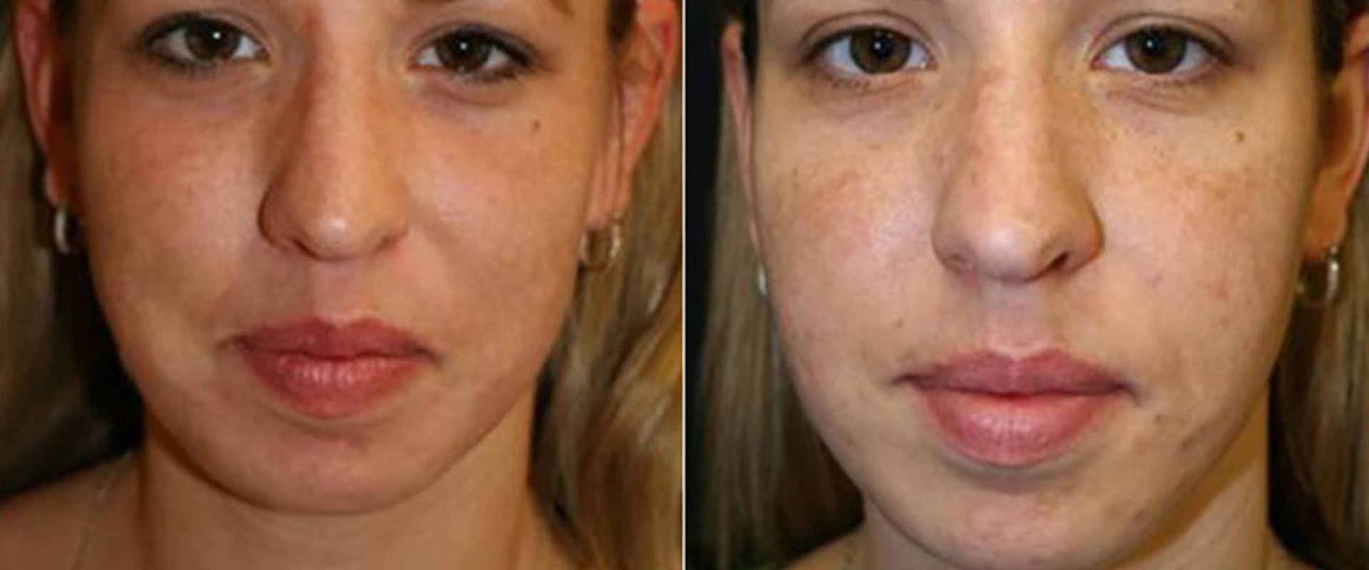 How Many Laser Hair Removal Sessions Do You Need?