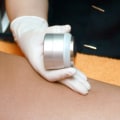 What Happens After 3 Laser Hair Removal Treatments?