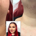 Laser Hair Removal for PCOS: Is it Effective?