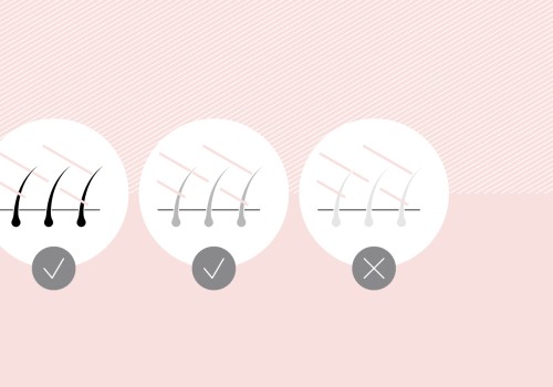 Can Laser Hair Removal Work on Blonde Hair?