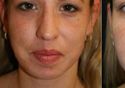 How Many Laser Hair Removal Sessions Do You Need?